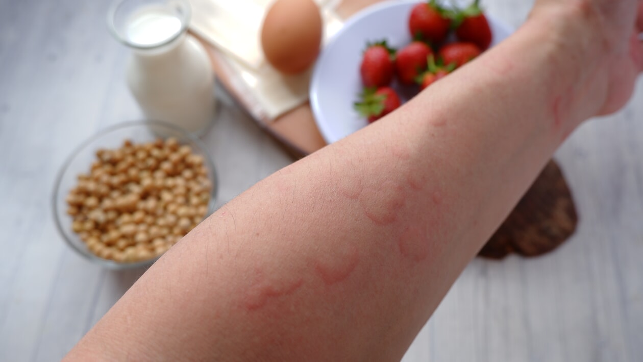 arm with hives and food in the background